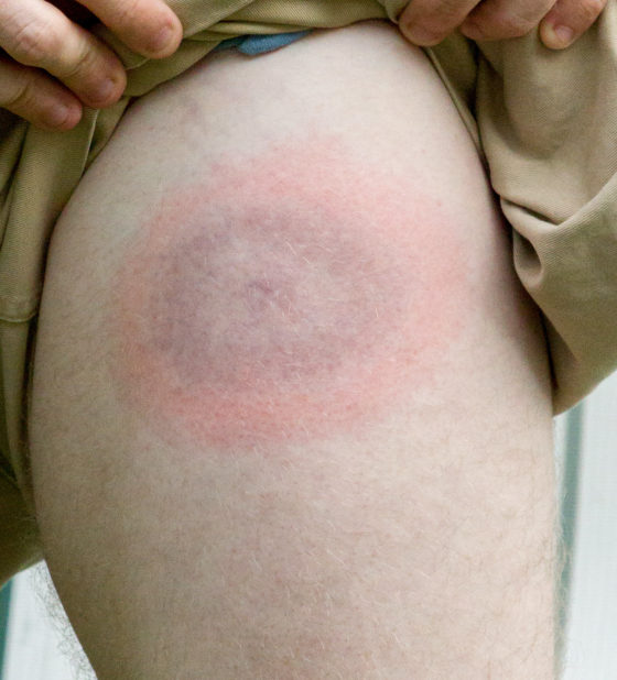 Photo of bull’s-eye rash from tick-borne disease